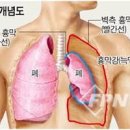 결핵 폐렴 기흉 완치 가능할까? 원인 증상 치료 이미지