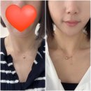 600 | 신사역 피부과 올타이트리프팅 600샷 내돈내산 후기(즉각 변화)