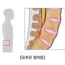 건강_척추관협착증이란? 이미지