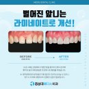 앞니가 벌어졌다면? 부경대 치과 라미네이트