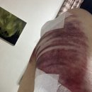 멍파티 | 결혼준비 2-1) 팔뚝 무한람스 일주일 후기 / 멍파티 / 통증