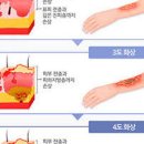 뜨거운물 화상 기름 화상 차이 통증 1도 2도 3도 치료 이미지