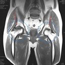 [고관절통증] -고관절통증에 대해 알아볼까요? 이미지