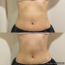 연제구-131 | [연산동 연제구 피부, 체형교정 에스테틱 : 아르...관리 받고 만족한 찐 후기 (복부 비포 애프터/복부...