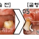 수플란트치과병원 네이버블로그