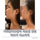 개롱역4번출구 | 가락동피부관리 라보아 - 티리온 리프팅 효과 솔직 후기