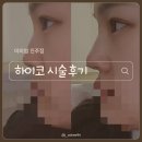 하이코코이비인후과의원 | 진주 피부과 미미썸진주점 코필러 하이코 내돈내산 솔직후기