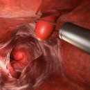 ‘대장내시경 완벽 가이드’… 수면 vs 비수면 선택 기준과 검사 주기는? 이미지