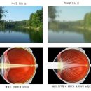 [봄의약속안과] 과도한 스마트폰 습관으로 인한 노안 급증!!!!!! 노안과 함께 오는 백내장 수술은 무엇일까요? 이미지
