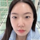 로제피부과의원중앙점 | 얀피부과 쥬베룩 볼륨 3회차 팔자/옆볼 후기