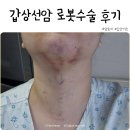 병상일기 2. 갑상선암 삼일병원 구강로봇 수술후기 통증 및 퇴원, 수술비용