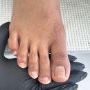 비네일(b nail) | 반복되는 내성발톱 고통, 동탄 무드비네일에서 근본 교정으로 해결하자