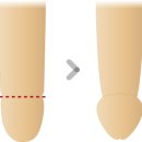 연세탑비뇨기과의원 | 💙 무통 레이저 포경수술/원주 비뇨기과 연세플러스