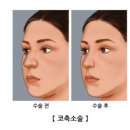 불만족스러운 코의 모양 flat nose, saddle nose, hump nose 성형미용 이미지