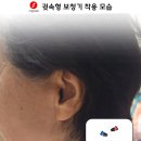 시그니아 독일 보청기 이미지