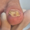 레푸스삼성점 인디고네일 | 논현역 내성발톱 두꺼워진 발톱 무좀 해결 후기