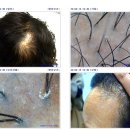 힐링센타부산안락점 | 부산 대연동 탈모관리 두피케어 전문센터 [ 모앤두피탈모 부산경성대점 ] 엄마의 찐후기❤️