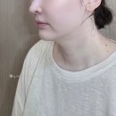 심부볼 처짐, 마리오네트주름 리프팅시술 리니어지 1,000샷 광주 성형외과 전문의 상담,시술 후기 내돈내산