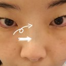 (주)푸른생활환경 | [시술 2일차] 코리프팅 코끝 붓기·통증 변화, 일상생활 괜찮을까?