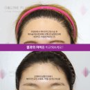 앤(N)서울신경외과의원 | 모발이식 재수술 │ 흉터·밀도·모류 방향을 교정한 헤어라인 재건