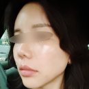 강남비비의원 | 강남역 피부과 강남비비의원 앞볼, 눈밑, 팔자, 턱끝 울트라콜 200후기🖤