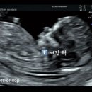 양수농원 | 남편이 쓰는 임신일기 - 12주차 입체초음파 &amp; 니프티 검사
