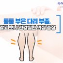 다리 부종 원인 (다리 붓는 이유) 마사지하기 이미지