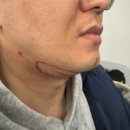 맘스외과성형외과의원 | 부천성형외과 <은삼성의원성형외과> 부천눈밑지방제거 후기 , 부천아큐스컬프 후기