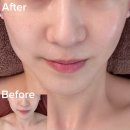바른약국 | 정발산피부샵 더바른뷰티 문제성피부 플라즈마 관리 후기 효과 전후비교