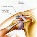 왼쪽 어깨 회전근개 파열 이미지