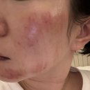 넘어져서 얼굴 피부 박살났는데 3개월만에 피부 소생한 사람의 피부 재생 추천템..★ 이미지