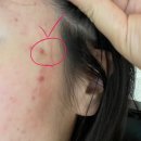 위례포에버의원 | 위례 포에버의원 아쿠아필, 염증주사 내돈내산