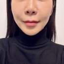 (주)라인호텔명동 | 명동 을지로입구역피부과 티타늄리프팅 내돈내산 일주일차 후기 이번주일상