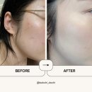 남서울한의원 | 화**한의원 강서목동점 거우침 서울 편평사마귀제거 4주차 후기 (지금은 티도 안 나요)