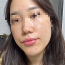 에드뷰티랩 | [두피,피부] 일산 대화동 피부관리 가을철 여드름관리 스칼프디자인센터 알엔뷰티랩