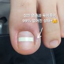 드림포유 | [긴급 아픈 발톱 관리 후기] 내성발톱 관리로 유명한 네일포유를 찾으시는 이유가 있습니다.