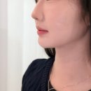 더 볼륨 | 압구정 피부과 앞광대 필러 더채움으로 볼륨 채우고 온 리얼 후기