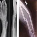 원위 요골과 척골 골절[Fracture of distal radius and ulna]근골격질환 이미지