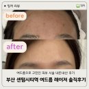 센텀뫼비우스 | [밍끼리뷰] 부산 얼태기 극복, 해운대역 피부과 여드름관리 골드PTT 받고온 후기