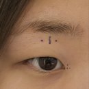 아이쿨안경 소하점 | 인생 처음으로 쌍수하고 온 후기 (수술 당일 0일차~5일차)