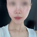 하이엔드 멍 | 강남 하이엔드 팔자주름 필러 붓기, 가격, 부작용 후기 [내돈내산]