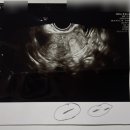 광주병원 | [임신 기록] 자궁기형/쌍각 자궁 조영술 초음파 결과/광주 기독병원 MRI 촬영 후기
