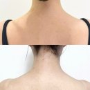 천호역 피부과 신부 웨딩관리 국산 승모근보톡스 통증 효과 1회차 후기