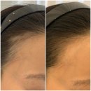 오케이 메디칼 | 오케이메디컬뷰티센터 건대 자연눈썹 건대 틴트입술 잘하는곳 헤어라인 관리 후기