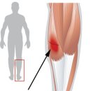 잘못된 페달링으로 인한 무릅 통증 원인 이미지