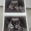 경부 T/G | 21주 분당제일병원 정밀초음파 후기
