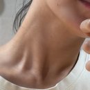 인천 부평 피부과 목주름필러 실리프팅 같이한 후기