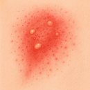 피내농장 | 피내 구더기증(피부유충이행증) 벌레가 피부 속에서 움직이는 듯한 느낌, 왜 생길까?