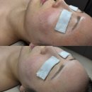 메디팜 새보람약국 | 1년 넘게 다닌 상봉 찐단골 에스테틱 리브르 마이크로젯 500샷 2차 받고 피부 인생 달라진 후기