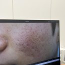 대구한의원 | 대구 피부과 한의원 여드름 패인 흉터 제거 새살침 후기 기록 내돈내산 치료